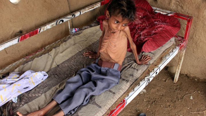 Cientos de niños padecen desnutrición en Yemen.  La guerra civil de 7 años entre las fuerzas progubernamentales y los rebeldes huzíes ha llevado al país al borde de la hambruna./Foto: AFP