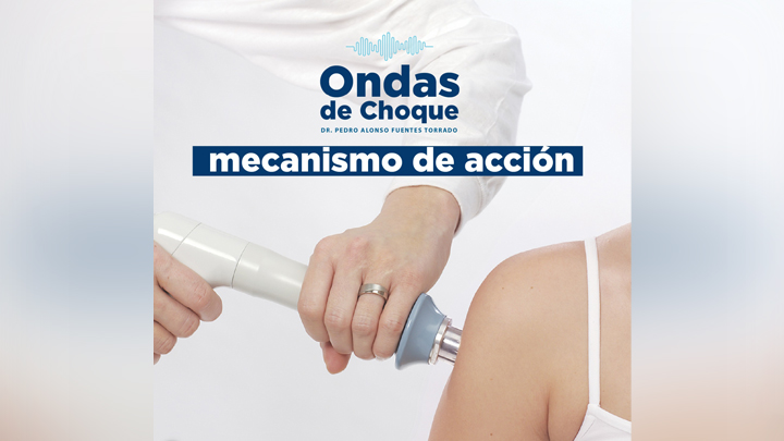 Las ondas de choque son una innovadora terapia para combatir dolores articulares.