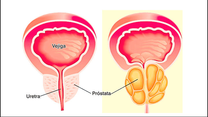 próstata 2