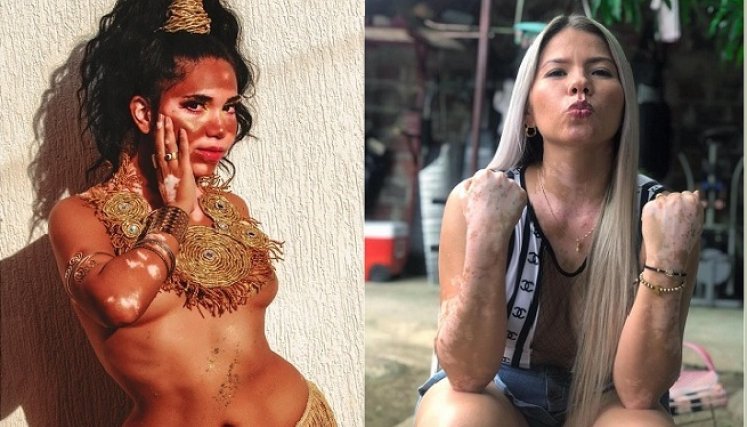 Mujeres con vitíligo