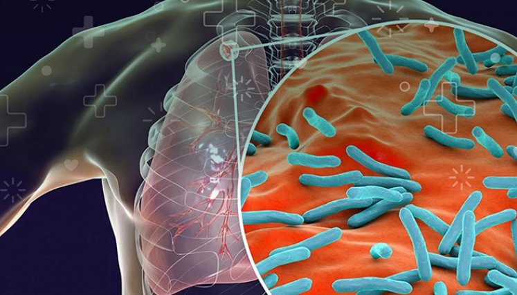 La tuberculosis es una de las principales causas de muerte en personas viviendo con VIH en el mundo.