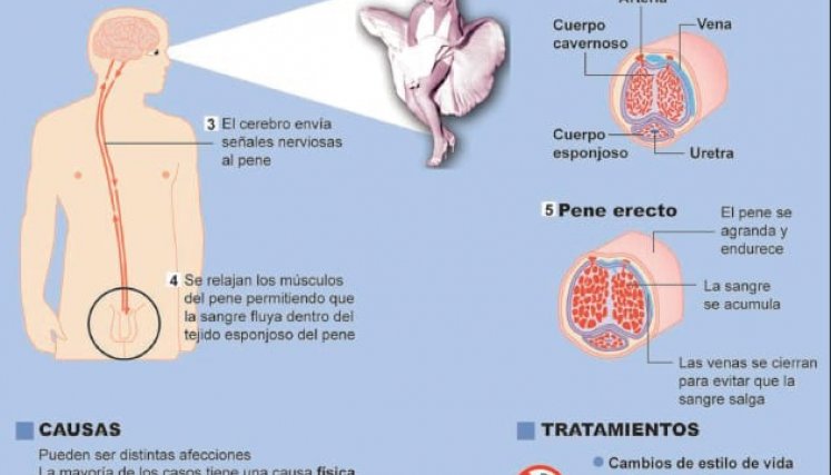 Disfunción eréctil.