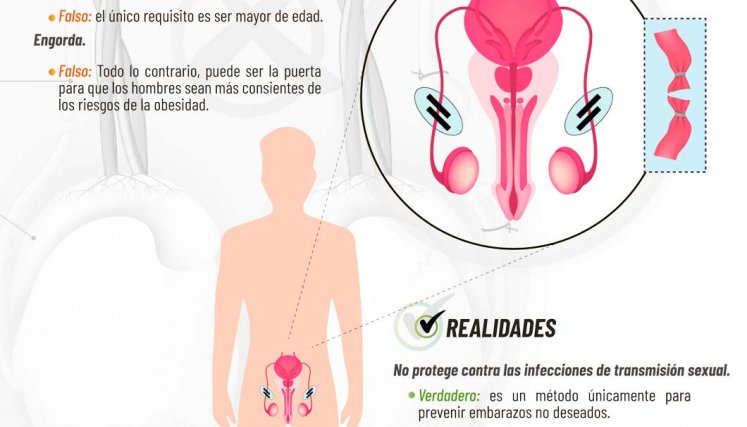Mitos vasectomía
