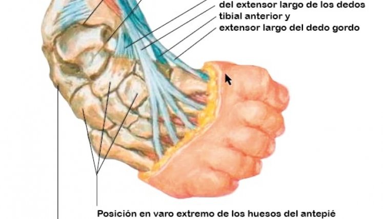 No existe total claridad médica o científica sobre las causas del pie equinovaro, que puede ser leve o grave. / Gráfico La Opinión