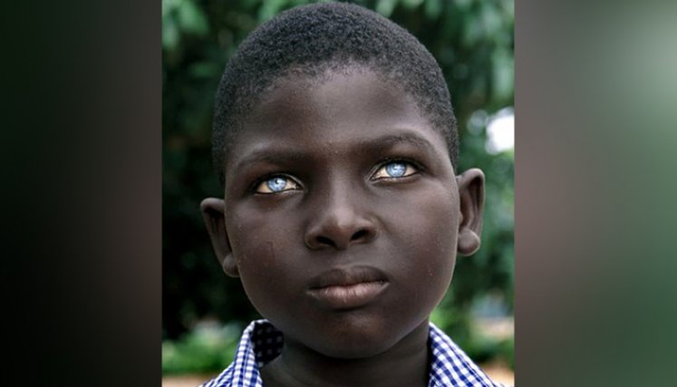 Albinismo ocular: una afección heredada en los ojos./Foto: tomadas de https://superatuenfermedad.com/