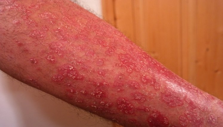 El 14 de septiembre es el Día Mundial de la Dermatitis Atópica. / Cortesía 