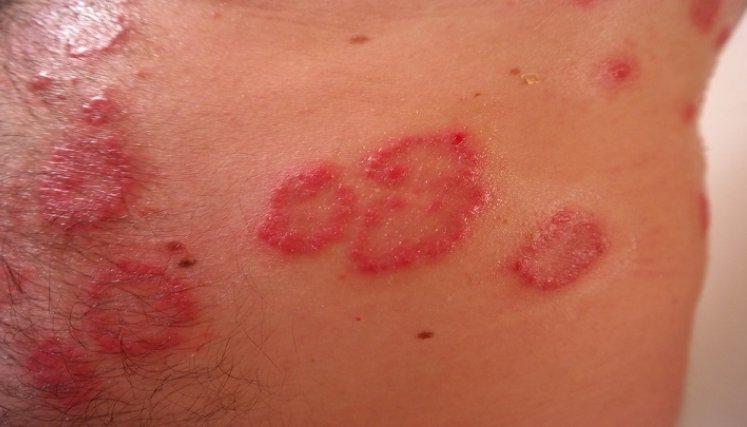 •	En Colombia, la prevalencia aproximada de personas con dermatitis atópica es de 9% en adultos y 12% en adolescentes.  /Cortesía