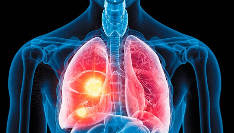 Pulmones. 