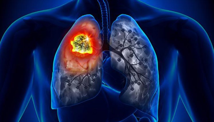 Fibrosis pulmonar