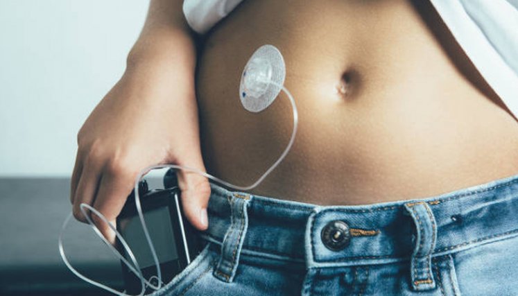 La diabetes es una enfermedad crónica que aparece cuando el páncreas no produce insulina suficiente o cuando el organismo no la procesa eficientemente. / Foto: Cortesía