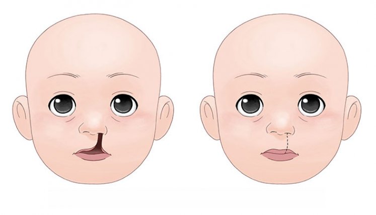 Cómo mejorar la calidad de vida de los niños con labio y paladar hendido