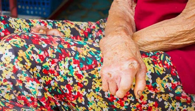 Los ojos, las manos y los pies son las áreas corporales más afectadas./ Foto: Cortesía 