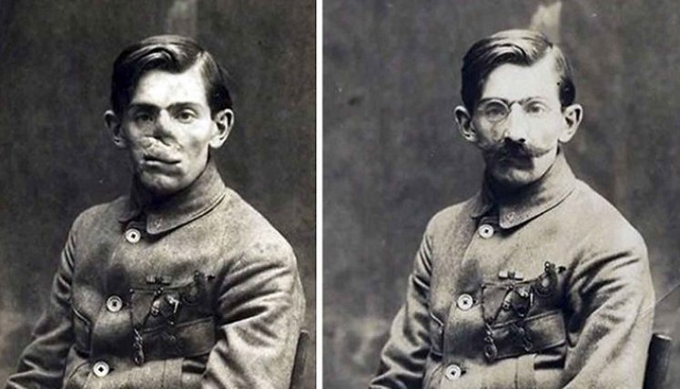 También dieron paso a la cirugía estética, plástica, reconstructiva, debido a la magnitud de las afectaciones físicas./Foto: internet