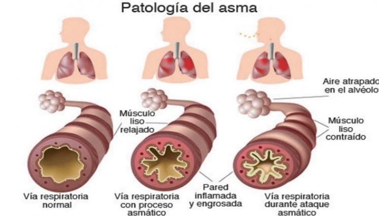 Así se ve la enfermedad. / Foto: Cortesía / La Opinión 
