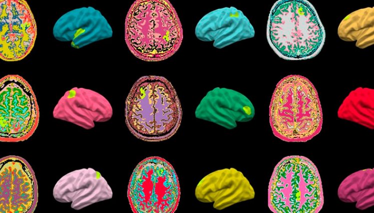 Inteligencia artificial podría ayudar a curar la epilepsia