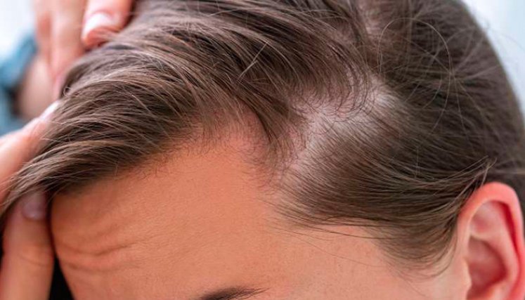 Alopecia.