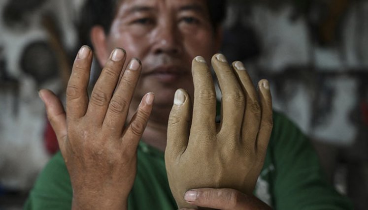 En Indonesia, piernas nuevas para recuperarse de la lepra./Foto: AFP