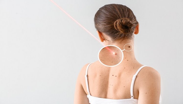 Melanomas. / Foto: Cortesía