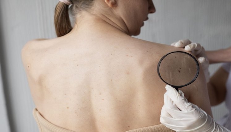 Cáncer de piel. / Foto: Cortesía