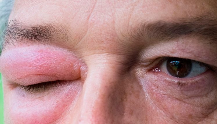 Angioedema Hereditario 