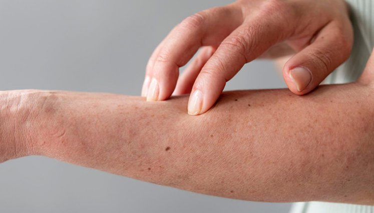 dermatitis