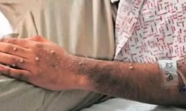 En Antioquia fue confirmado el primer caso de viruela símica del tipo más grave/Foto Colprensa
