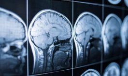 Crean herramienta con IA para un diagnóstico temprano del alzhéimer a través del sueño
