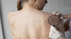Cáncer de piel. / Foto: Cortesía