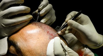 La moda de los trasplantes capilares esconde mortales peligros en India