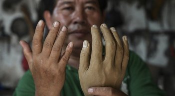En Indonesia, piernas nuevas para recuperarse de la lepra./Foto: AFP