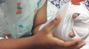 Aumentó el número de quemados  con pólvora en Norte de Santander
