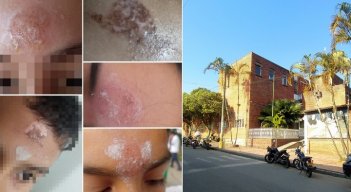 Quemados con ceniza en Chinácota