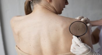 Cáncer de piel. / Foto: Cortesía