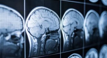 Crean herramienta con IA para un diagnóstico temprano del alzhéimer a través del sueño